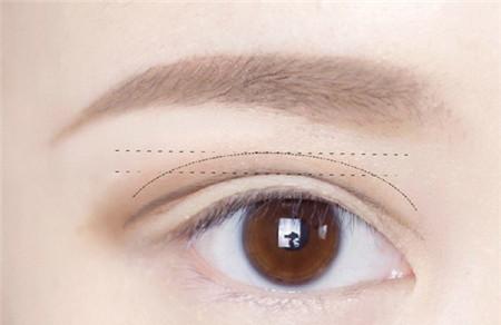 来月经可以做双眼皮手术吗 做双眼皮一定要注意这些！