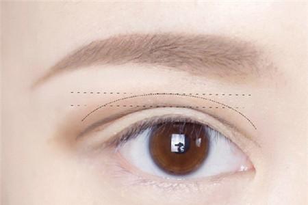 来月经可以做双眼皮手术吗 做双眼皮一定要注意这些！