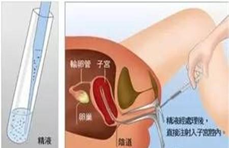 人工授精女方痛苦吗 不要太担心