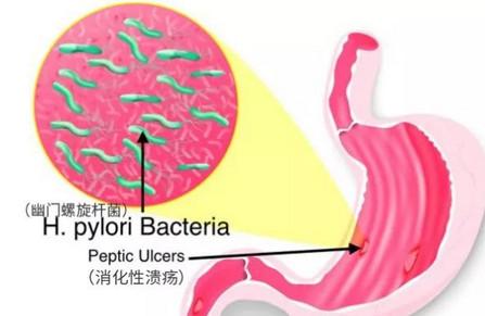 宝宝厌食偏瘦是幽门杆菌造成的吗
