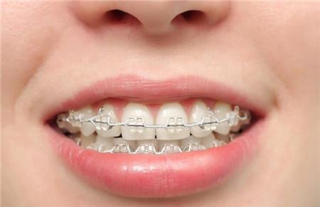 月经期可以矫正牙齿吗 矫正牙齿也要讲究时间