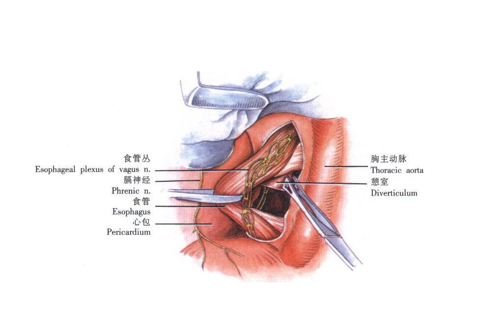 先天性食管狭窄是什么原因