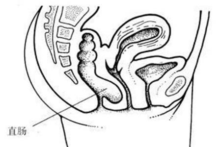 肛门指检能查出肠癌吗 肠癌症状要了解