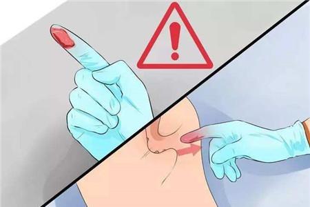 自己指检肛门的方法 自己操作要注意