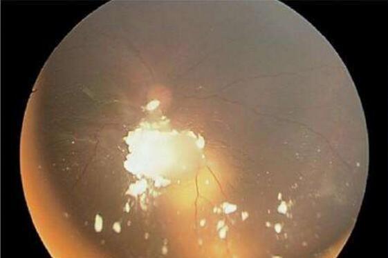 先天性白内障怎么办