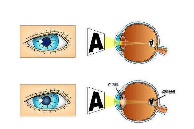 先天性白内障的分类