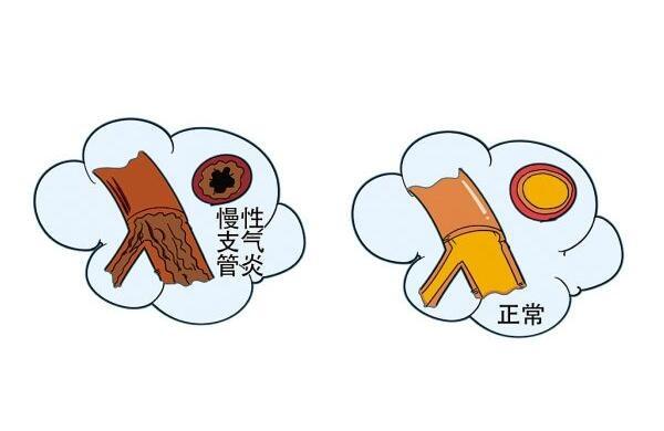 如何预防小儿慢性支气管炎