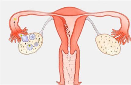 患多囊卵巢的人多吗 多囊是常见疾病吗？