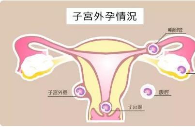 宫外孕能预防？备孕前请小心身体发出的这些信号！