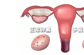 多囊卵巢跟湿气有关系吗 多囊是湿气重导致的吗？