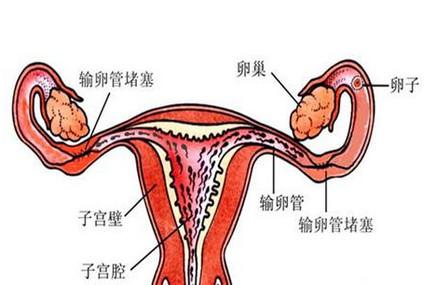 4个因素导致盆腔积液不易怀孕，女性要当心