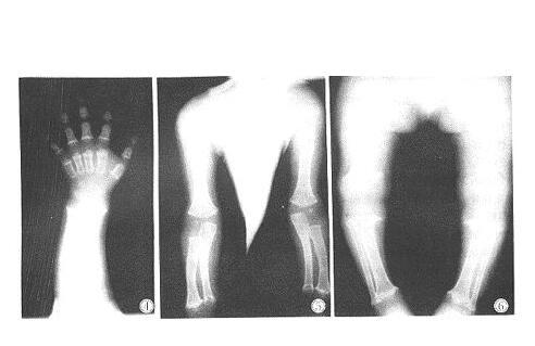 软骨发育不全治疗方法