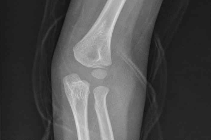 小儿风湿热护理措施