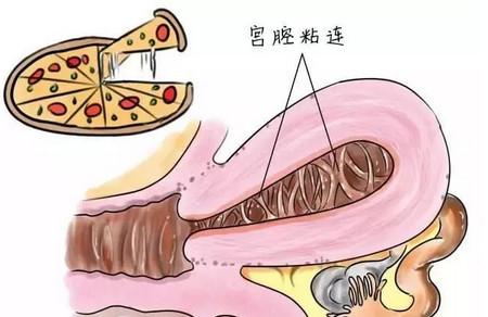 宫腔粘连是怎么回事？这些问题你可能需要知道