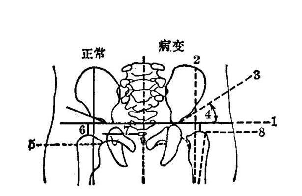 先天性髋关节脱位是什么原因