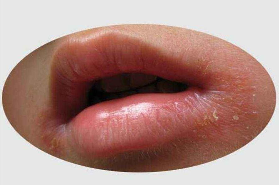 小儿口角炎的症状