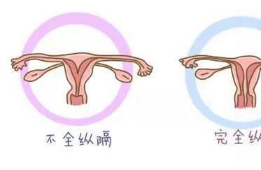 3分钟带你全面了解子宫纵膈！