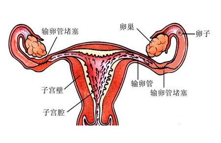 输卵管堵塞了还能怀孕吗？