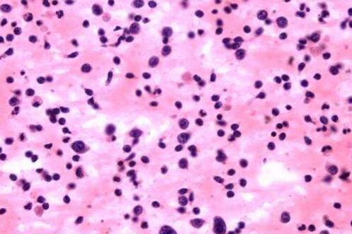 小儿紫癜是什么引起的