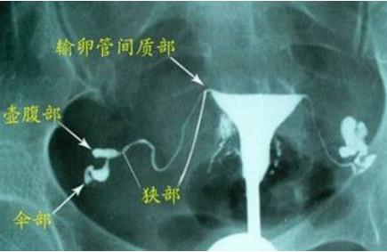 输卵管造影和输卵管通水有何区别？你知道吗？