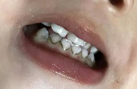 为什么宝宝牙齿越刷越黑