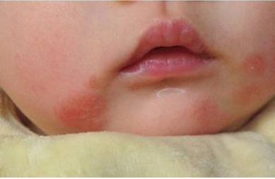 宝宝反复湿疹怎么办，如何治湿疹