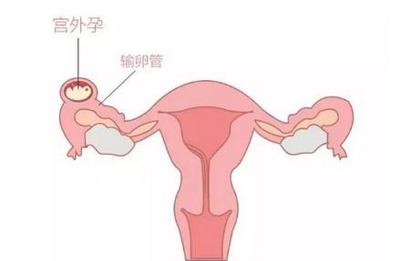 跳绳可以预防宫外孕吗