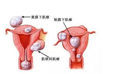 做试管婴儿有子宫肌瘤怎么办