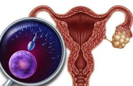 多囊卵巢综合征的备孕建议