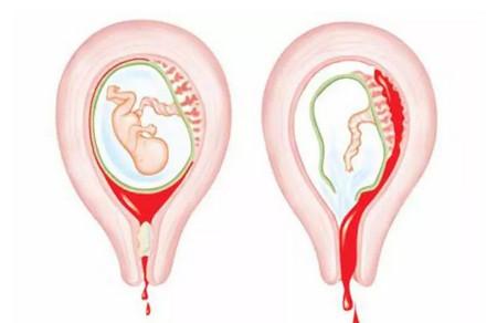 怀孕先兆流产如何保胎成功