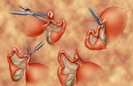 结扎后还想生怎么办