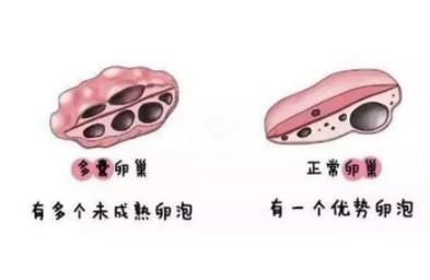 多囊卵巢综合征怎么怀孕