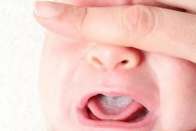 宝宝口中有白色东西是怎么回事