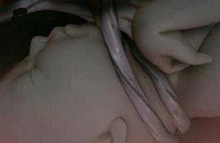 脐带绕颈怎么回事？新生儿脐带又该怎么护理？