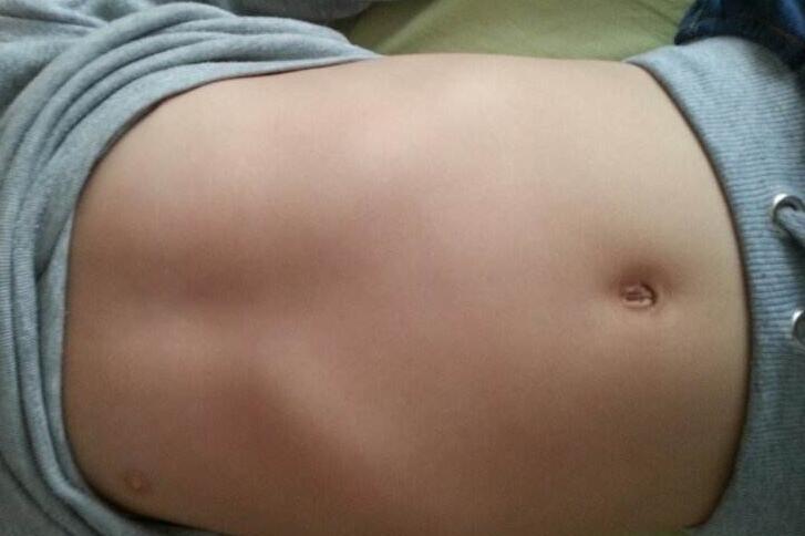 小儿肋骨外翻怎么办