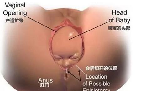 顺产侧切后的问题有哪些