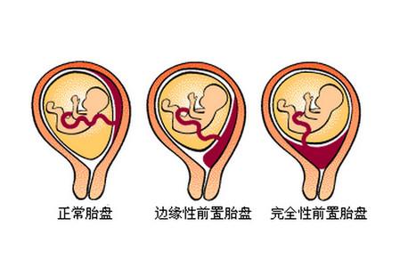 前置胎盘有哪几种