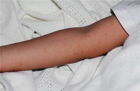 手臂上有小红点是艾滋病吗 艾滋病到底有哪些症状？