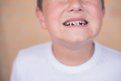 孩子蛀牙牙疼怎么缓解疼痛