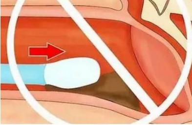 宝宝耳垢怎么清理