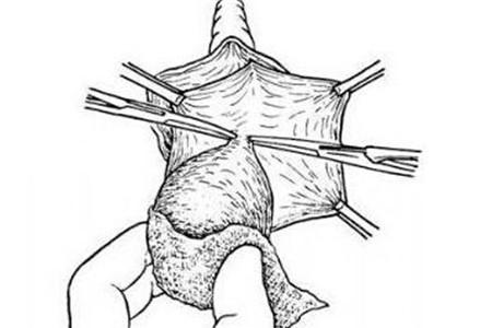 巴氏腺囊肿影响月经吗 巴氏腺囊肿会导致月经不调吗？