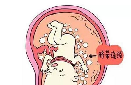 胎儿宫内缺氧是什么原因