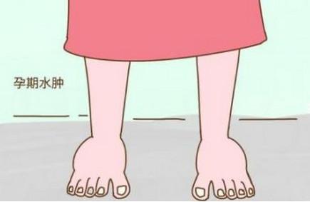 孕期腿脚水肿怎么办