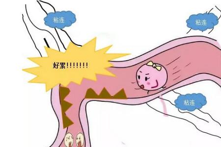 输卵管不孕是怎么回事