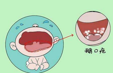 宝宝鹅口疮是怎么回事