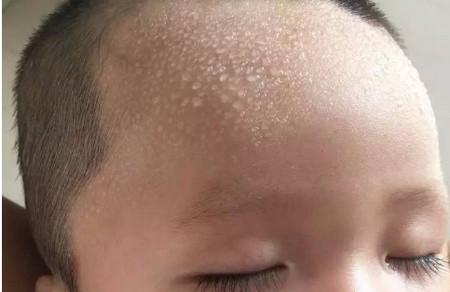 宝宝出汗多了怎么办