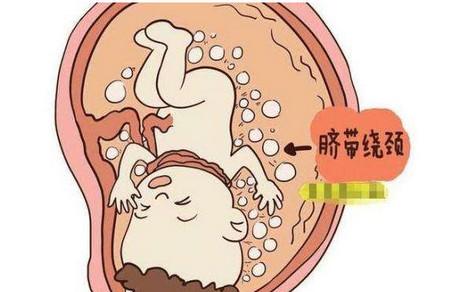 胎儿脐带绕颈时孕妇应该怎么办
