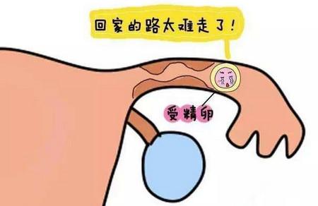 怎样预防宫外孕的发生