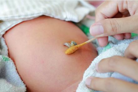 宝宝脐茸是怎么回事？该怎么治疗