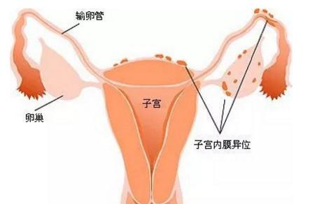 b超检查出少量盆腔积液怎么回事